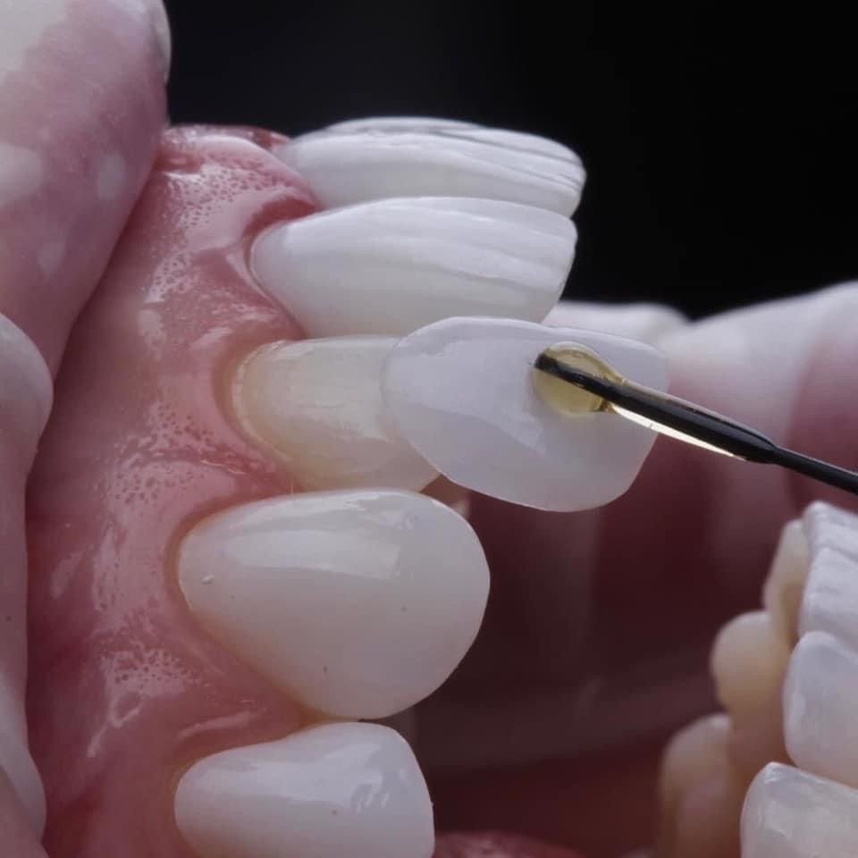 Dental veneers treatment