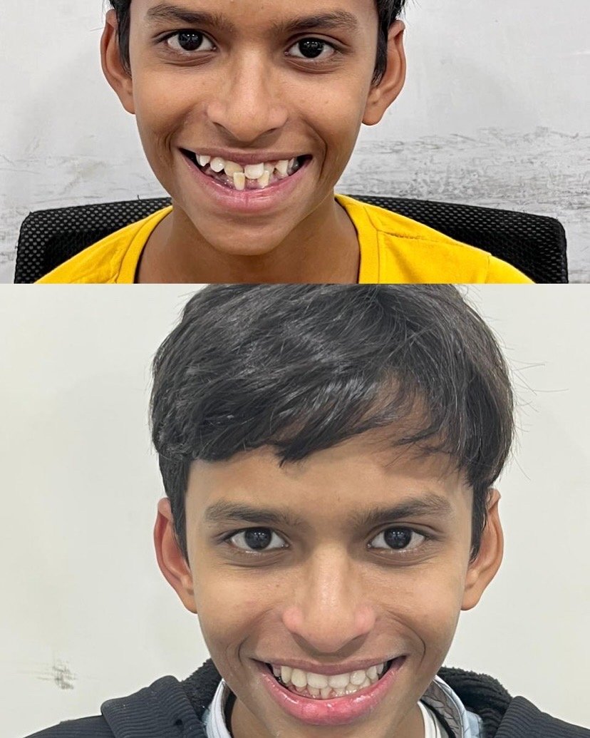 Clear aligner before and after