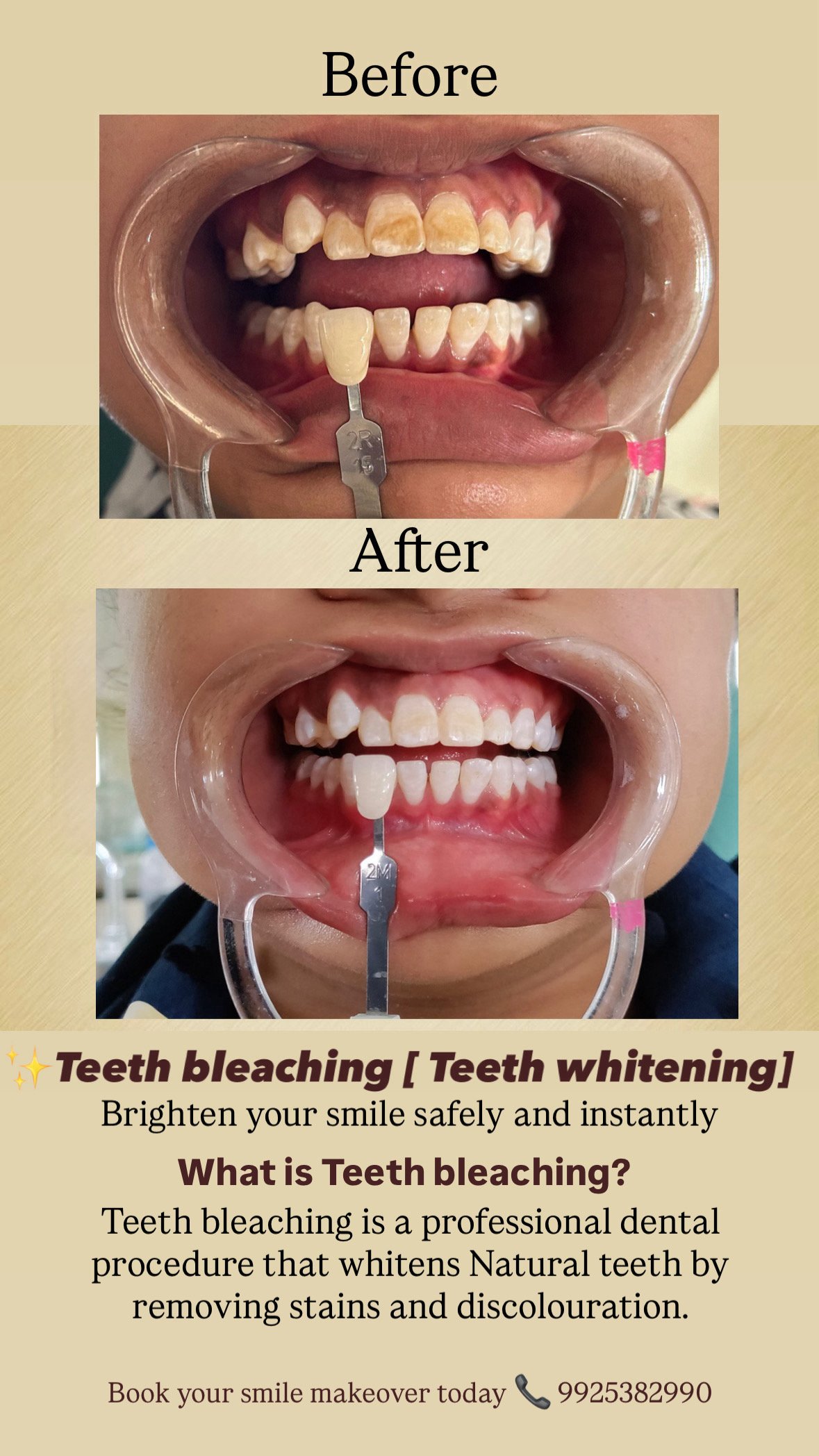 Fixed teeth before and after