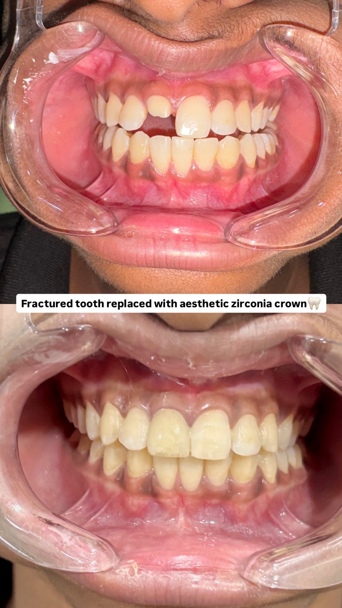 Teeth alignment before and after
