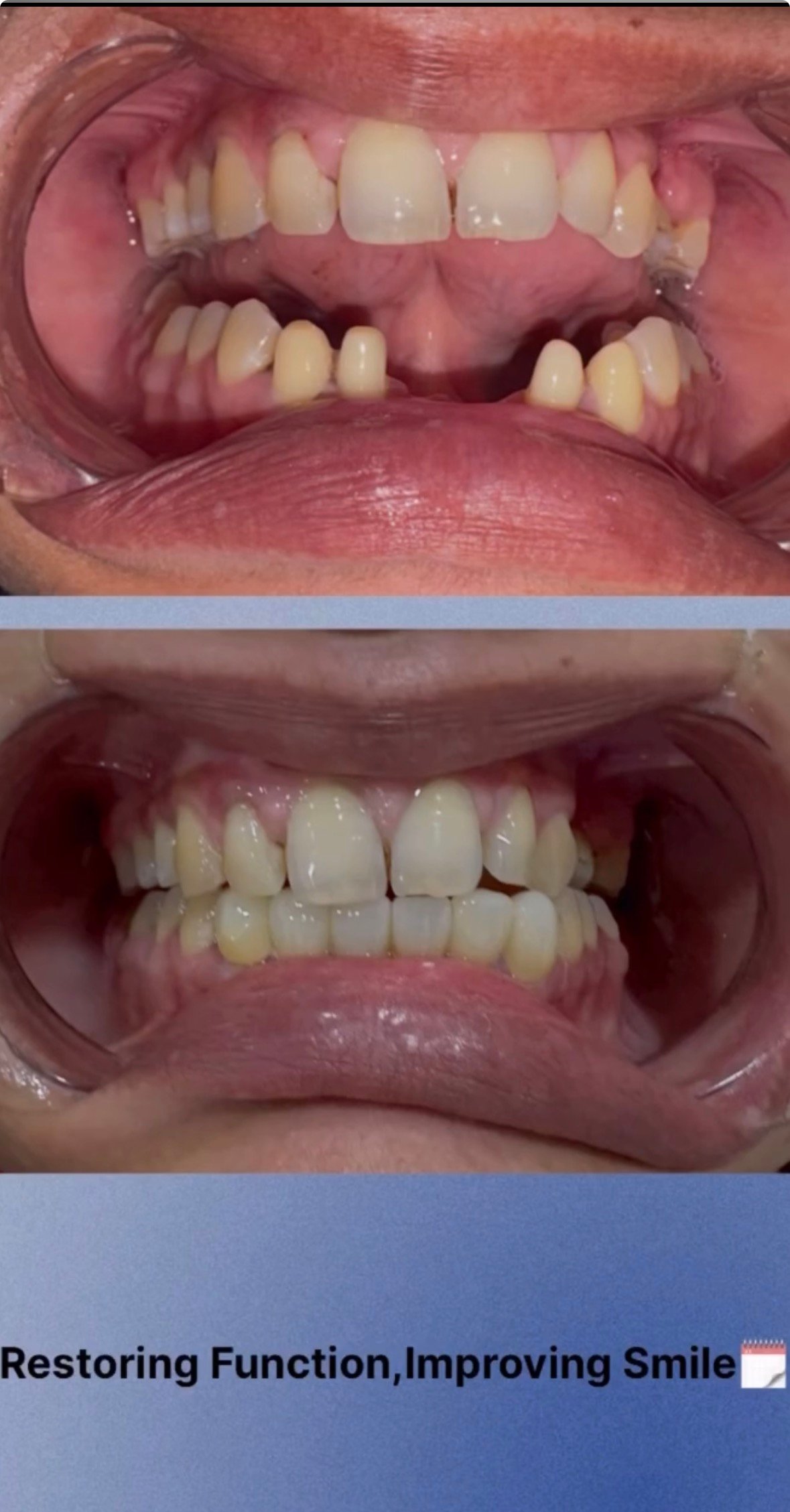 Smile makeover before and after