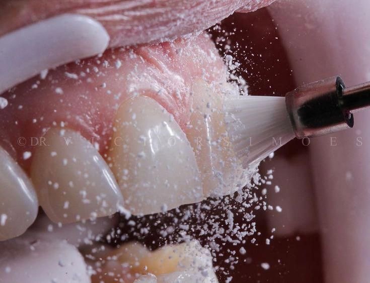 Root canal treatment