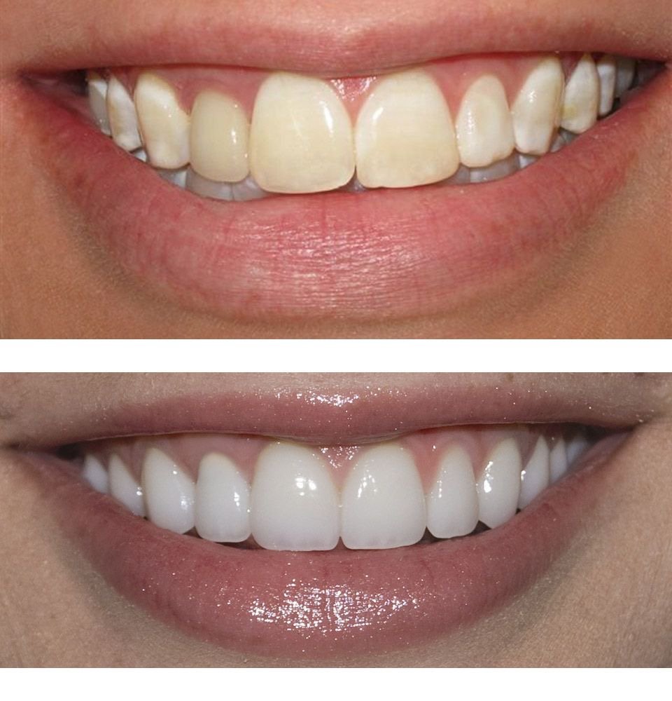 Orthodontic treatment
