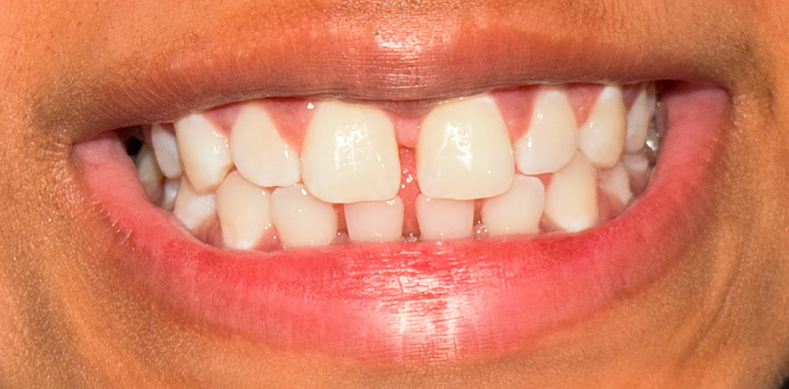 After dental treatment