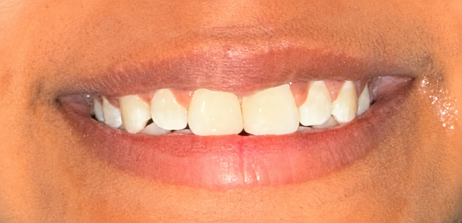 Before dental treatment