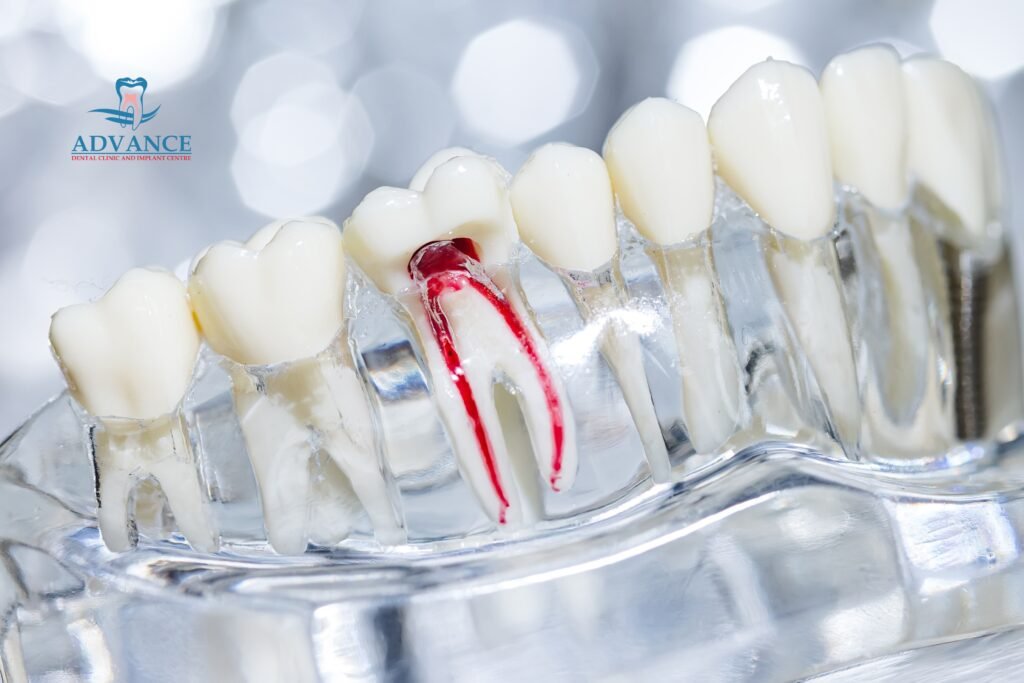 Root Canal Treatment: Pain, Procedure & When You Need It